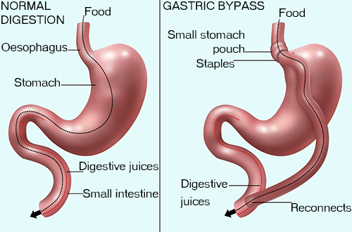 Risks Associated With Both Types of Bariatric Surgery
