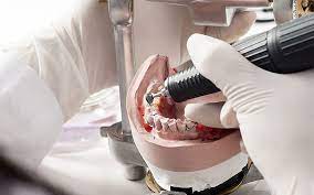 Quality Dental Prosthetics: Understanding Dental Lab Services