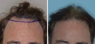 Cost Versus Value in Hair Transplant Procedures